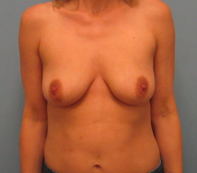 Breast Lift - Before